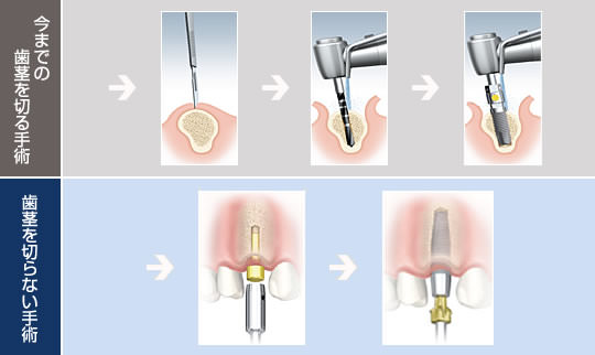 今までの歯茎を切る手術－歯茎を切らない手術