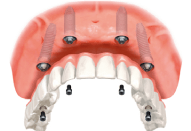 手術後すぐに固定式の歯が入ります。
